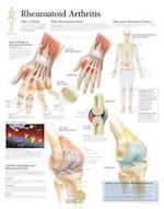 Rheumatoid Arthritis