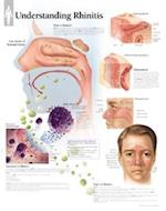 Understanding Rhinitis Chart