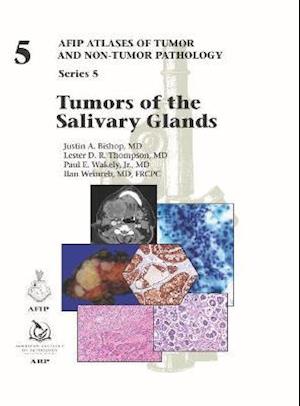 Tumors of the Salivary Glands