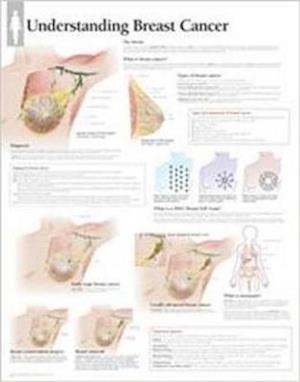 Understanding Breast Cancer Wall Chart