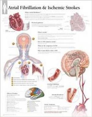 Atrial Fib & Ischemic Strokes Wall Chart