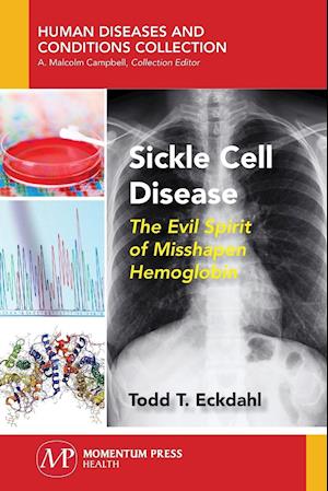 Sickle Cell Disease