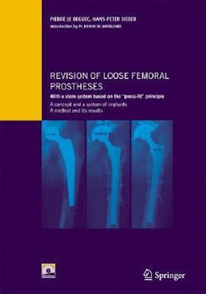 Revision of loose femoral prostheses with a stem system based on the "press-fit" principle