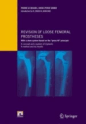 Revision of loose femoral prostheses with a stem system based on the 'press-fit' principle