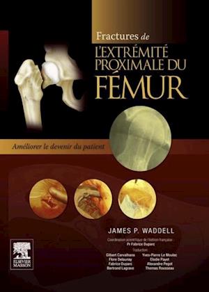 Fractures de l''extrémité proximale du fémur