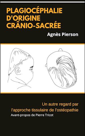 plagiocéphalie d'origine crânio-sacrée