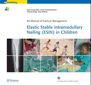 Elastic Stable Intramedullary Nailing (ESIN) in Children