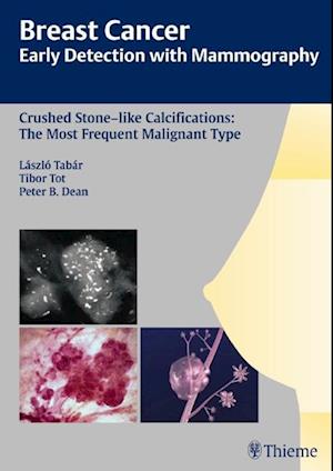 Breast Cancer: Early Detection with Mammography: Crushed Stone-Like Calcifications: The Most Frequent Malignant Type