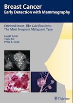 Breast Cancer: Early Detection with Mammography: Crushed Stone-Like Calcifications: The Most Frequent Malignant Type
