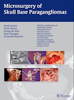 Microsurgery of Skull Base Paragangliomas