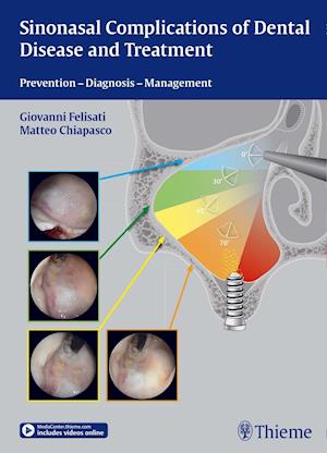 Sinonasal Complications of Dental Disease and Treatment : Prevention - Diagnosis - Management