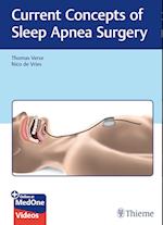 Current Concepts of Sleep Apnea Surgery