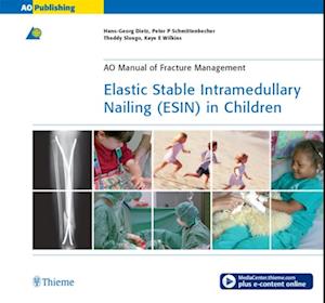 Elastic Stable Intramedullary Nailing (ESIN) in Children