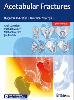 Acetabular Fractures