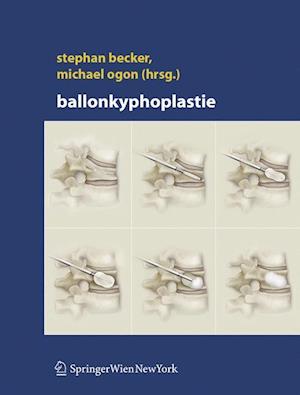 Ballonkyphoplastie