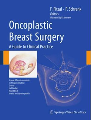 Oncoplastic Breast Surgery