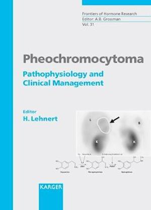 Pheochromocytoma