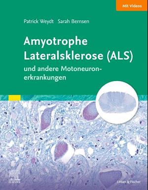 Amyotrophe Lateralsklerose (ALS) und andere Motoneuronerkrankungen