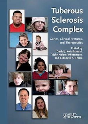 Tuberous Sclerosis Complex  Genes, Clinical Features and Therapeutics