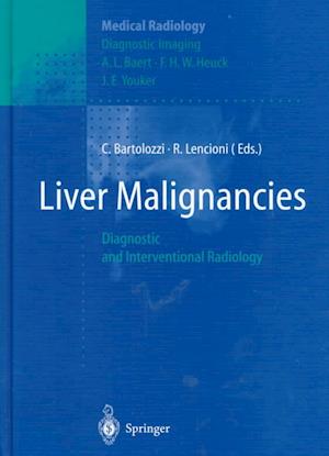 Liver Malignancies