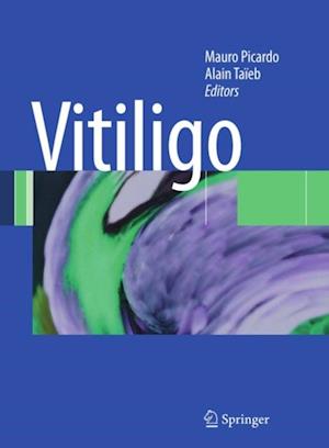 Vitiligo