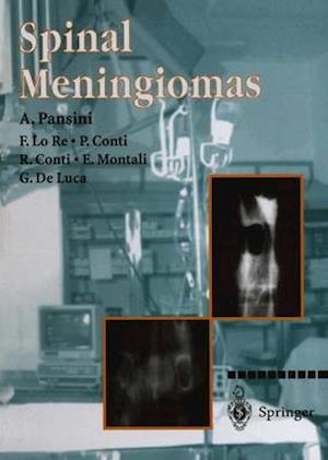 Spinal Meningiomas