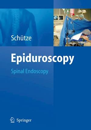 Epiduroscopy