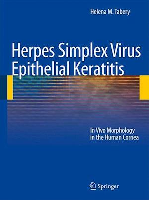 Herpes Simplex Virus Epithelial Keratitis