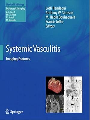 Systemic Vasculitis