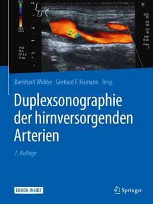 Duplexsonographie der hirnversorgenden Arterien