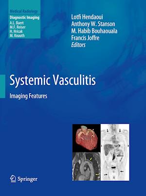 Systemic Vasculitis