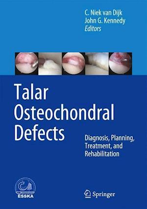Talar Osteochondral Defects