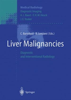 Liver Malignancies