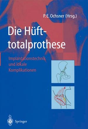 Die Hüfttotalprothese