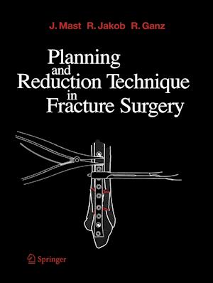 Planning and Reduction Technique in Fracture Surgery