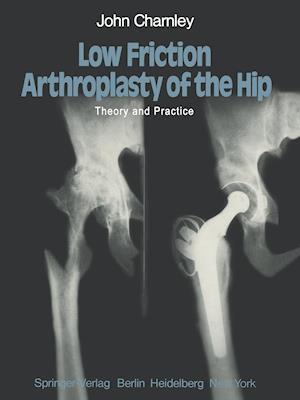 Low Friction Arthroplasty of the Hip