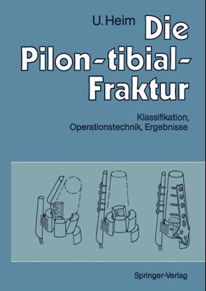 Die Pilon-tibial-Fraktur