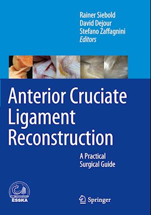 Anterior Cruciate Ligament Reconstruction