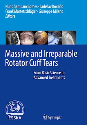 Massive and Irreparable Rotator Cuff Tears