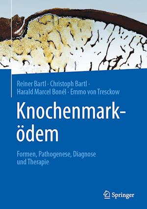 Knochenmarkoedem