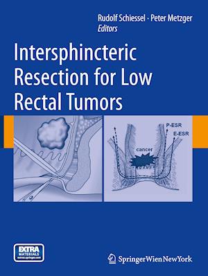 Intersphincteric Resection for Low Rectal Tumors