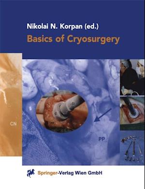 Basics of Cryosurgery