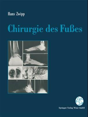 Chirurgie des Fußes