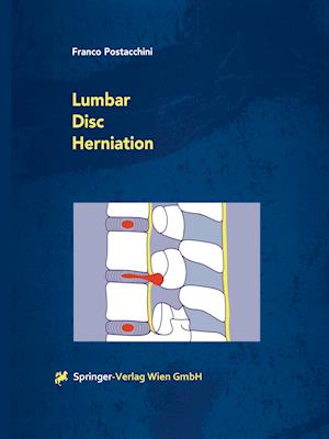 Lumbar Disc Herniation