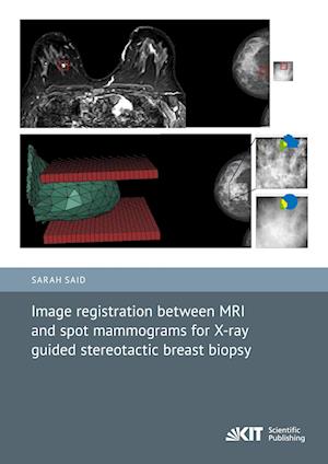 Image registration between MRI and spot mammograms for X-ray guided stereotactic breast biopsy