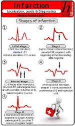 Infarction Localization, Leads & Diagnostics