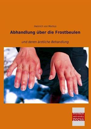 Abhandlung über die Frostbeulen