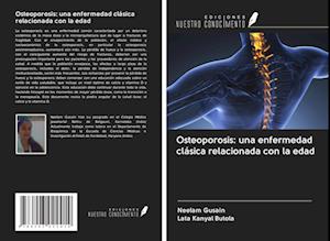 Osteoporosis: una enfermedad clásica relacionada con la edad