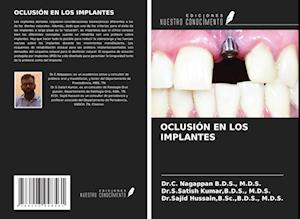 OCLUSIÓN EN LOS IMPLANTES