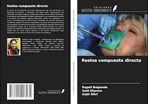 Resina compuesta directa